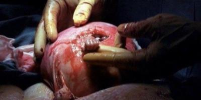 Feto de 21 semanas agarra dedo de médico