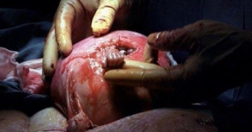 Feto de 21 semanas agarra dedo de médico